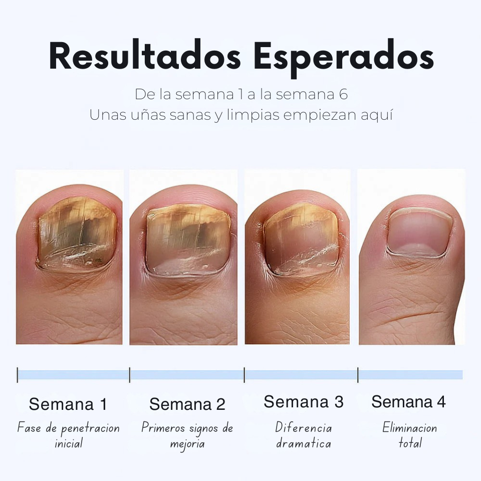 Parches Antihongos para Uñas