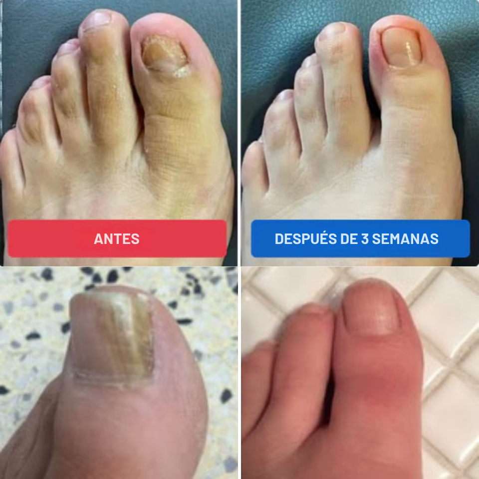 Parches Antihongos para Uñas